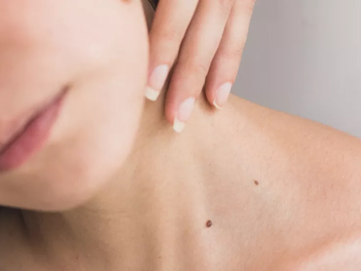 melanoma