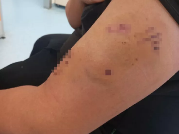 Σοκ στο Πέραμα: Σκύλος δάγκωσε 12χρονο μαθητή μπροστά στο σχολείο