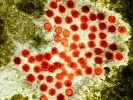 hepatitis