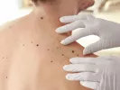 melanoma